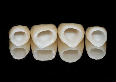 南京做烤瓷牙疼不疼及如何选择优质烤瓷牙与钢结硬质合金